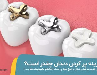 شاخص قیمت و هزینه پر کردن دندان