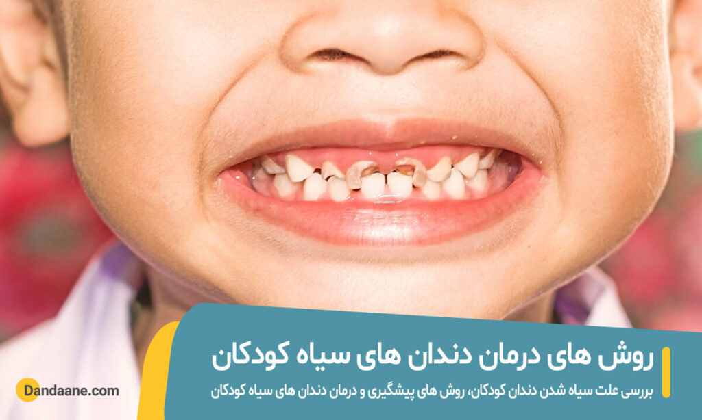 بررسی علت و درمان سیاه شدن دندان کودکان