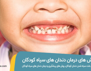 بررسی علت و درمان سیاه شدن دندان کودکان