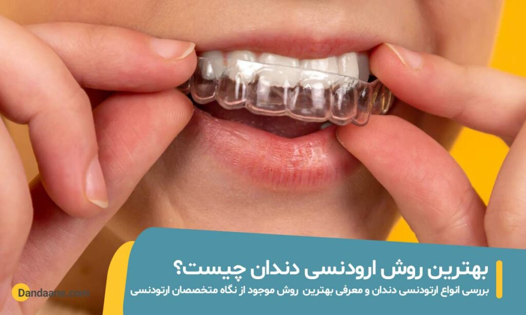بهترین روش ارتودنسی دندان