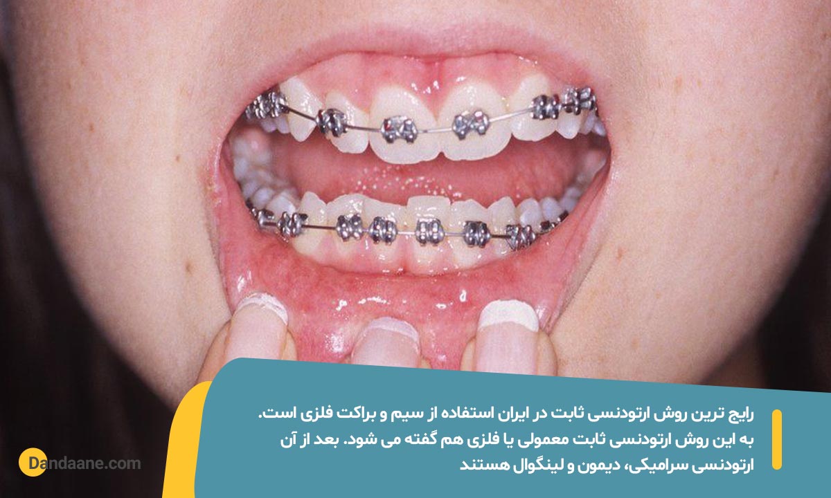 ارتودنسی ثابت نصب شده بر روی دندان های یک فرد