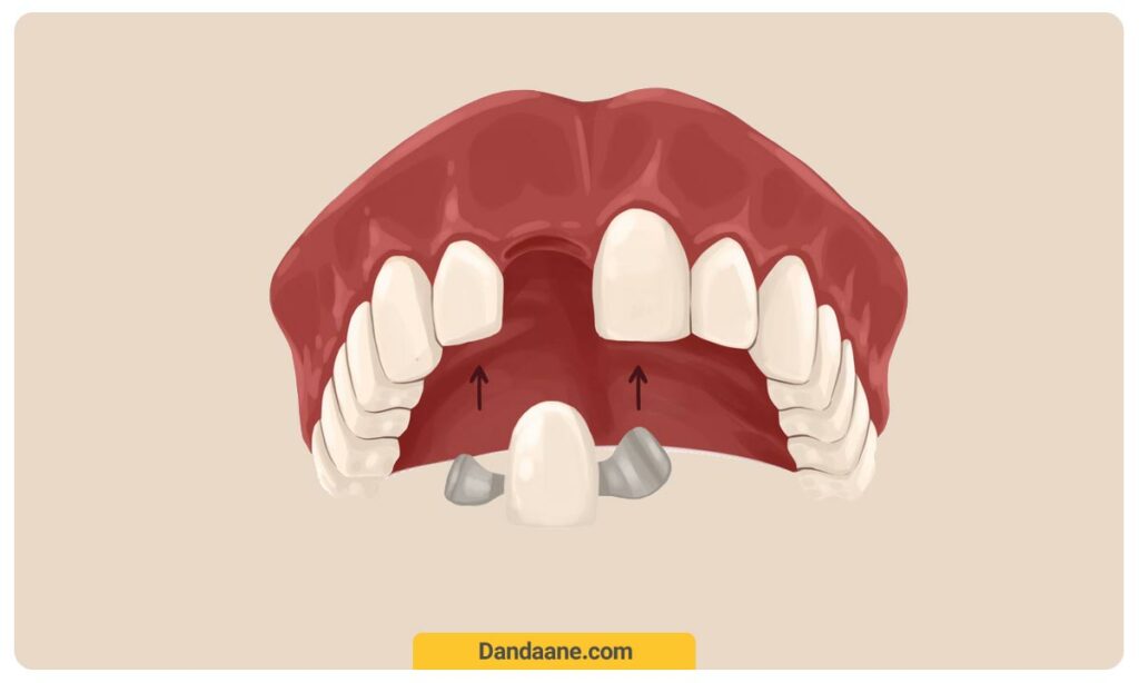 عکس بریج مریلند که یکی از کاربردهای کامپوزیت در دندانپزشکی اتصال این بریج به دندان های مجاور است