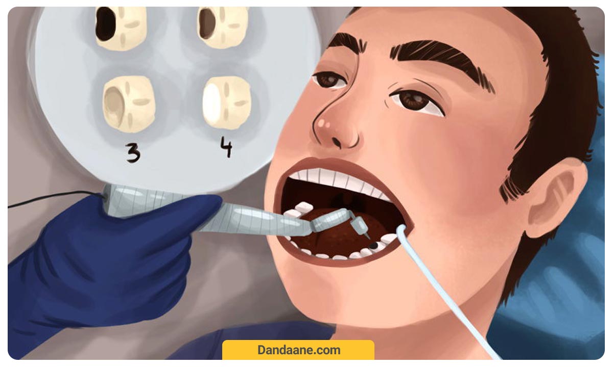 تصویر شماتیک پر کردن دندان