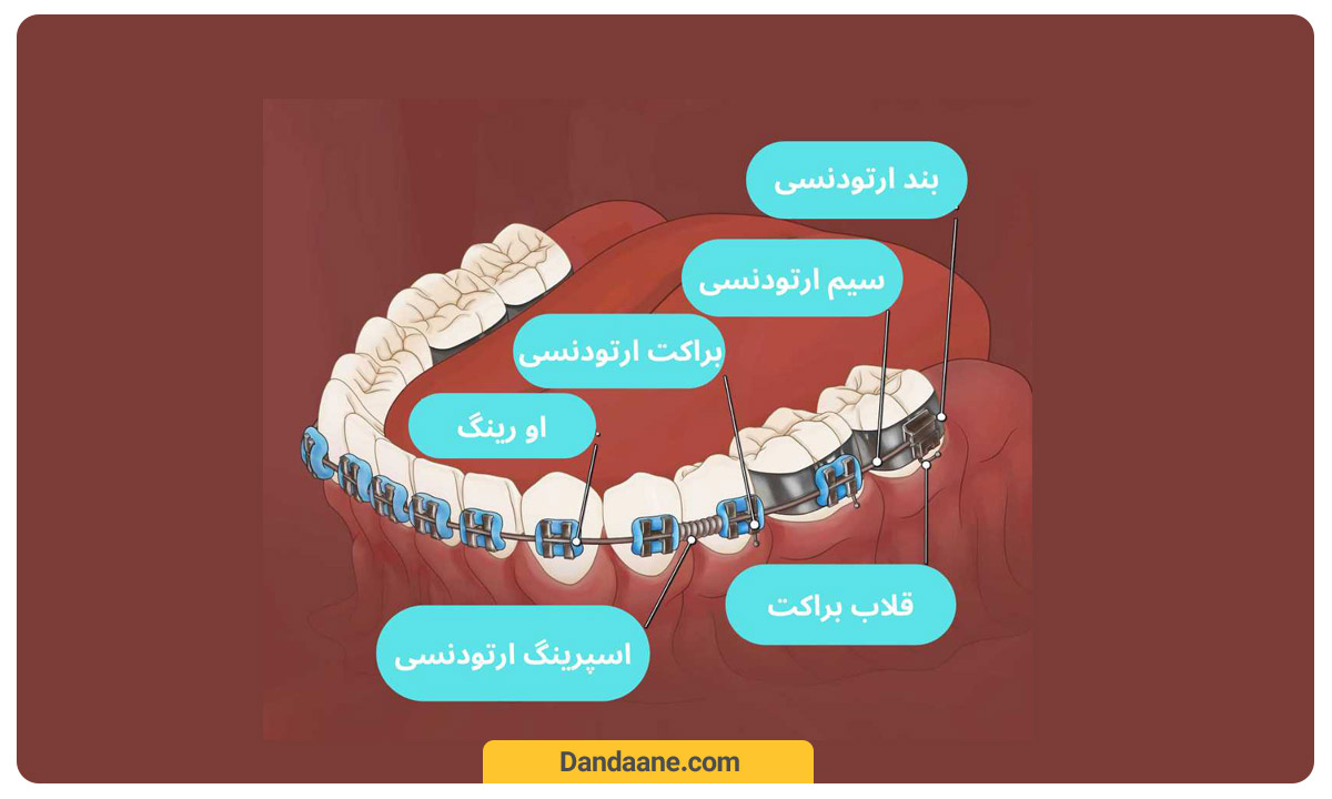 اجزای مختلف ارتودنسی ثابت