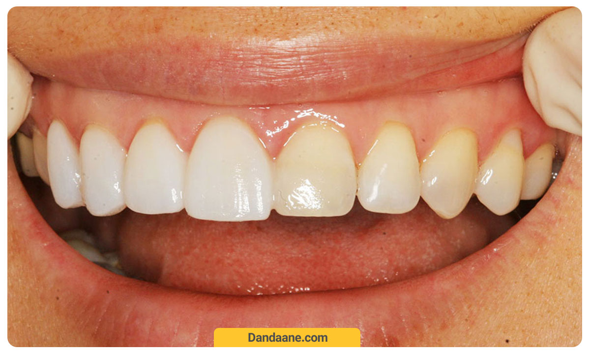 سفید کردن دندان ها و اصلاح طرح لبخند