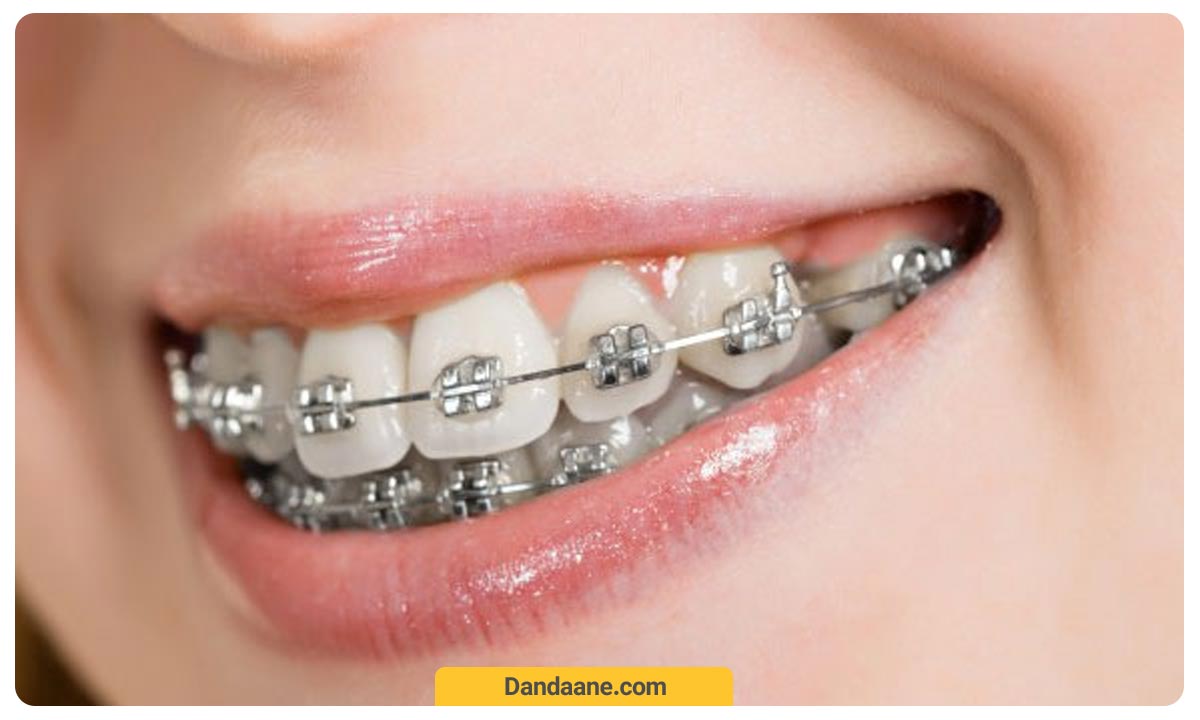 قرار گرفتن بریس ثابت ارتودنسی بر روی دندان