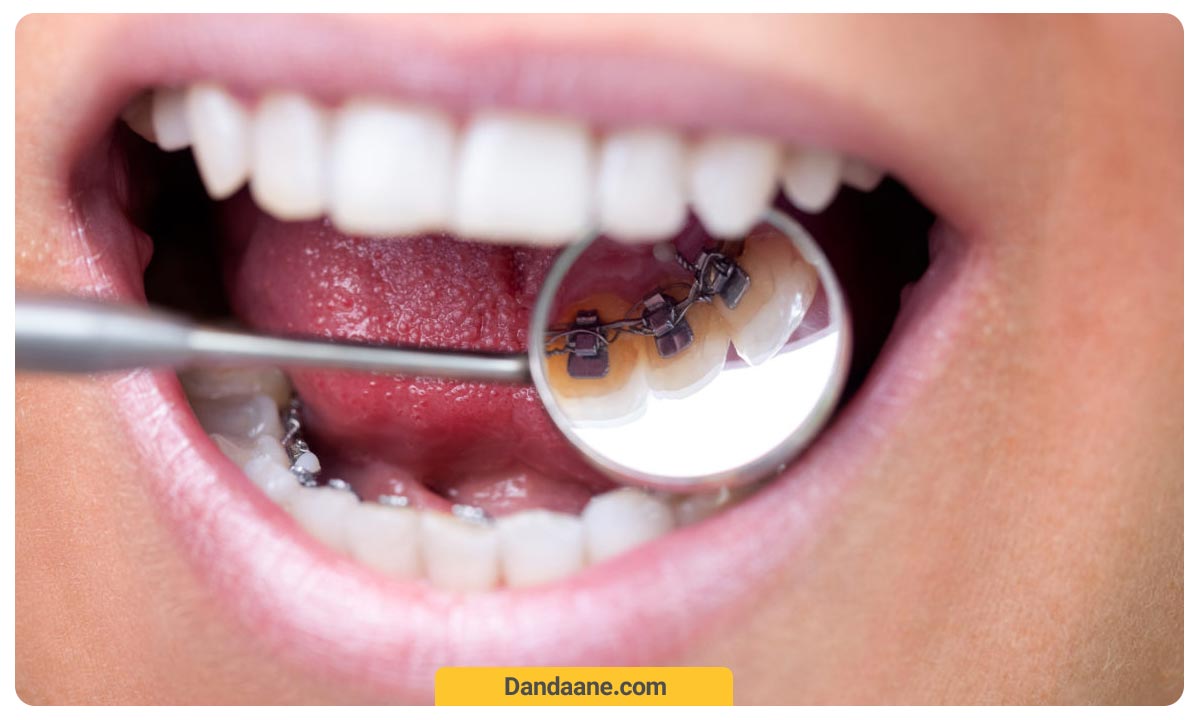 تصویر ارتودنسی پشت دندانی در آینه