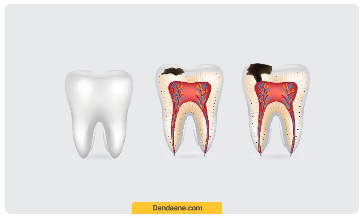 اینفوگرافی پالپیت که یکی از نشانه های آن می تواند درد دندان پر شده باشد