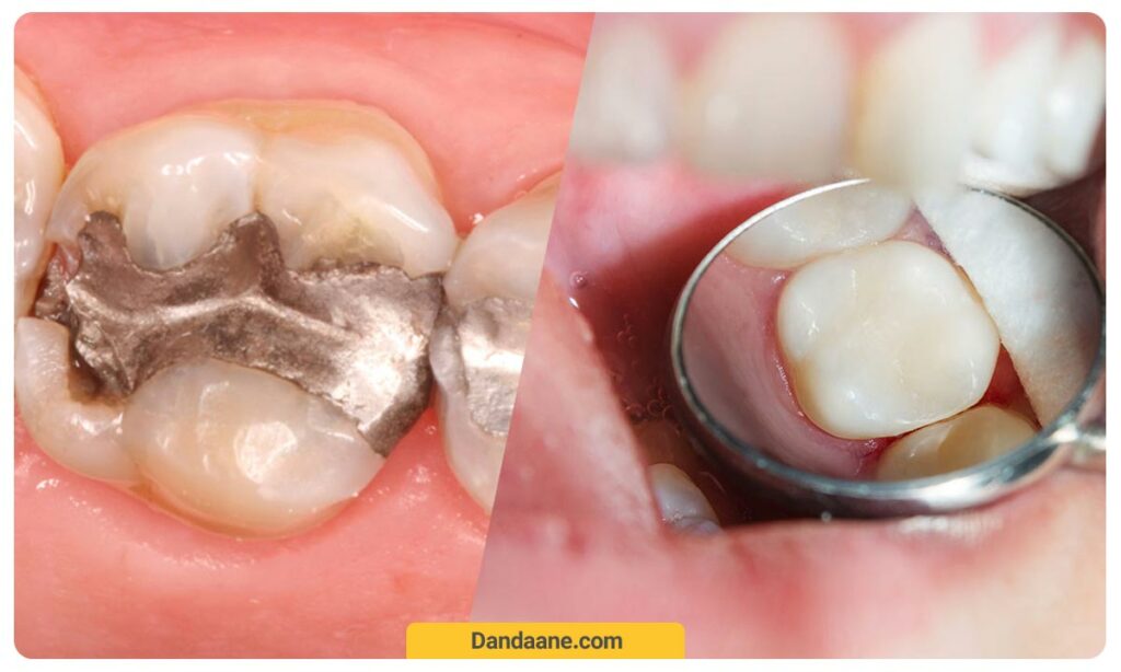 عکس تفاوت کامپوزیت و آمالگام در پر کردن دندان