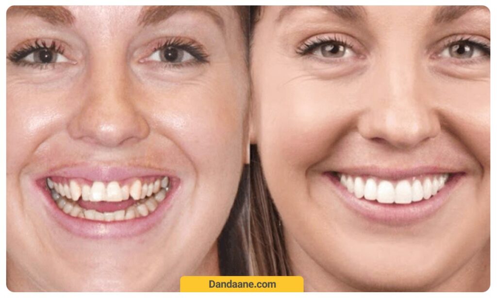 عکس طرح لبخند خانمی که دندان هایش را با کامپوزیت ونیر کرده است