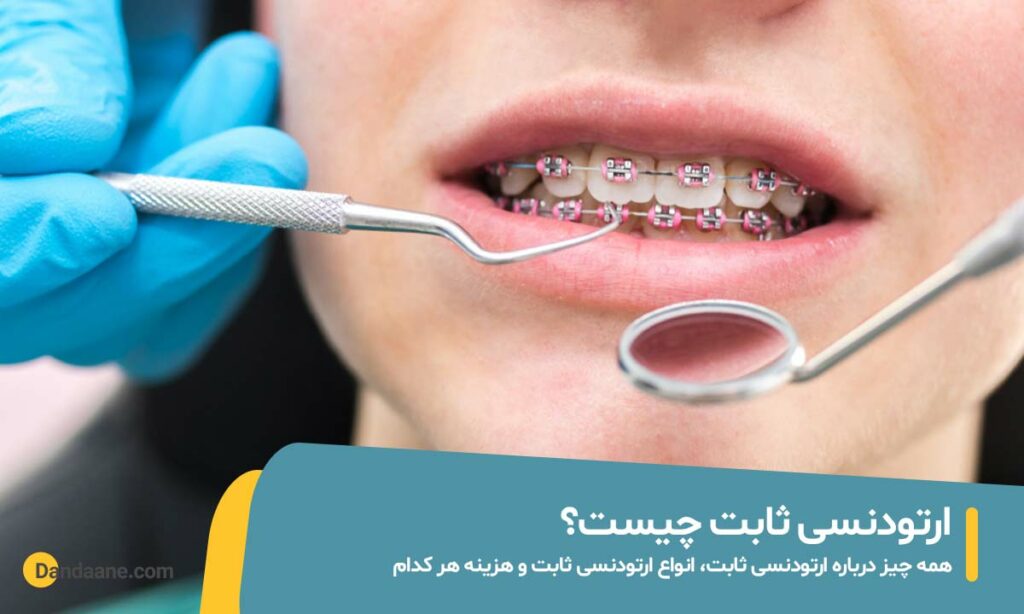 ارتودنسی ثابت چیست عکس