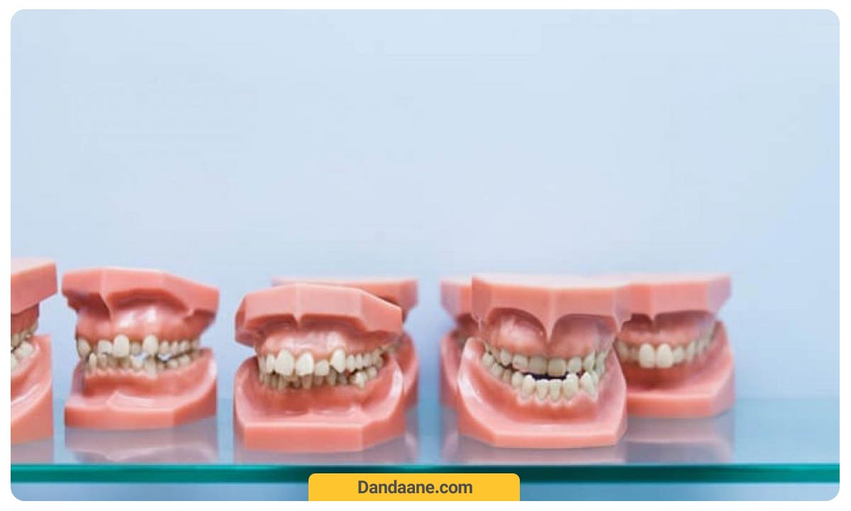 تصویر انواع مولاژ که ناهجاری های فکی و نامرتبی های دندانی را نشان می دهند