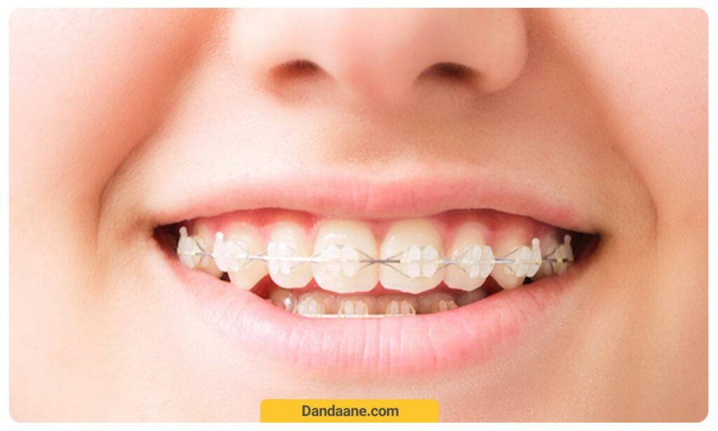 عکس ارتودنسی سرامیکی یک نوجوان که سیم و براکت هر دو سفید و همرنگ دندان هستند.