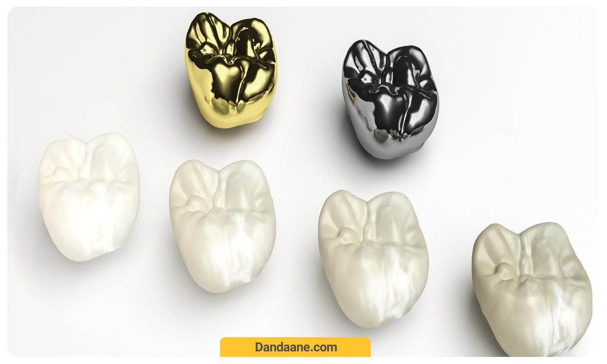 انواع مختلفی روکش های دندانی