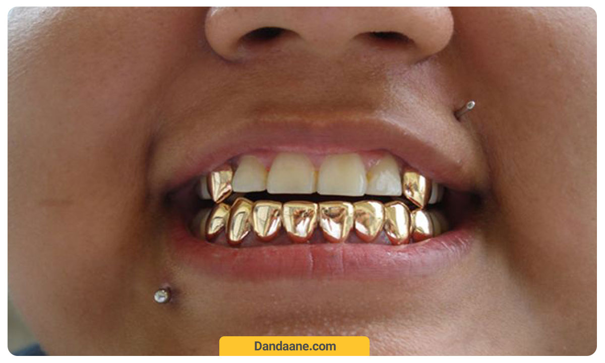 روکش دندان طلا بر روی دندان های جلو