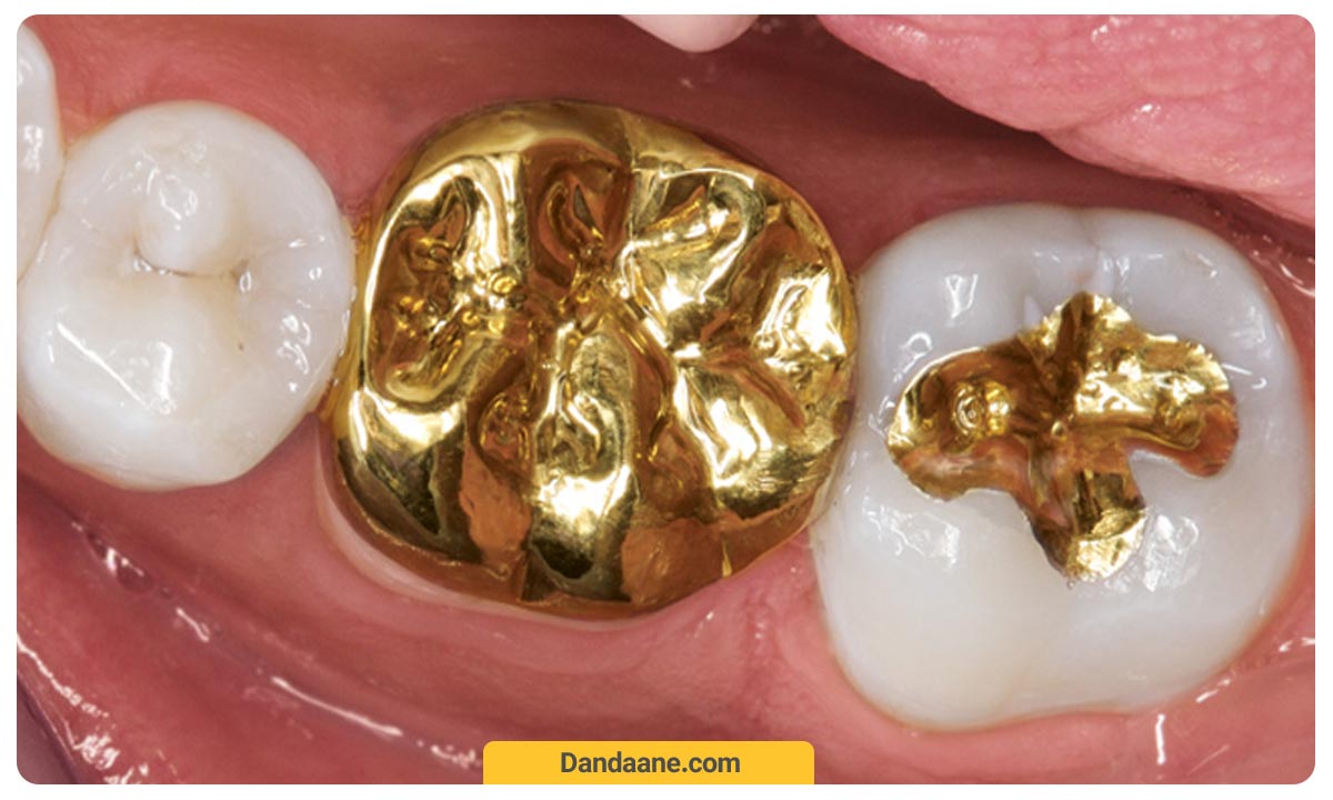 روکش طلا بر روی کل دندان