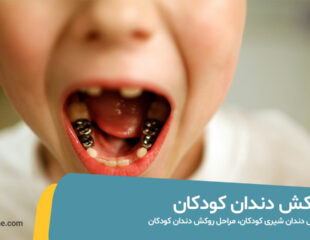 روکش دندان کودکان