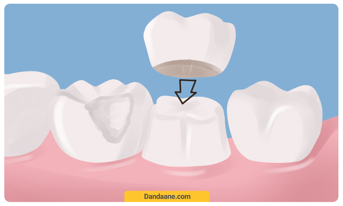 قرارگیری تاج دندان بر روی دندان