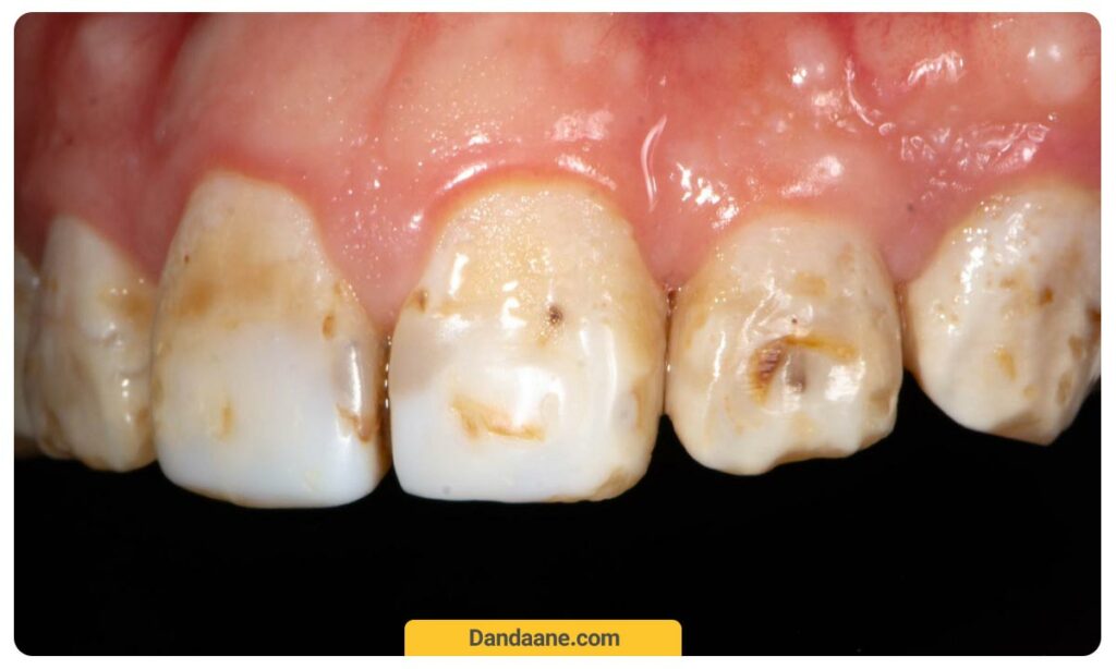 عکس پوسیدگی دندان جلو