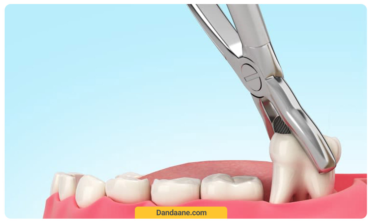 کشیدن دندان به روش معمولی 