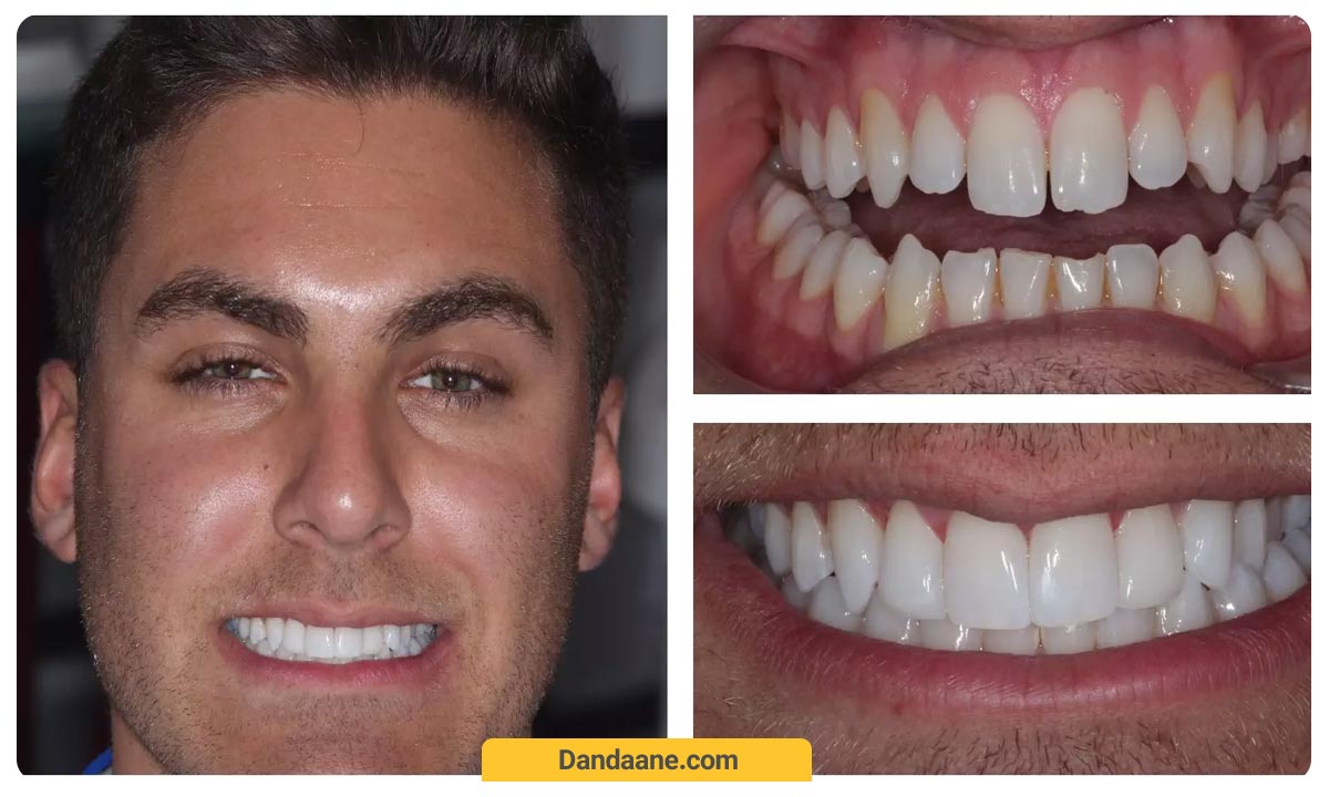 قبل و بعد پروسه باندینگ دندان