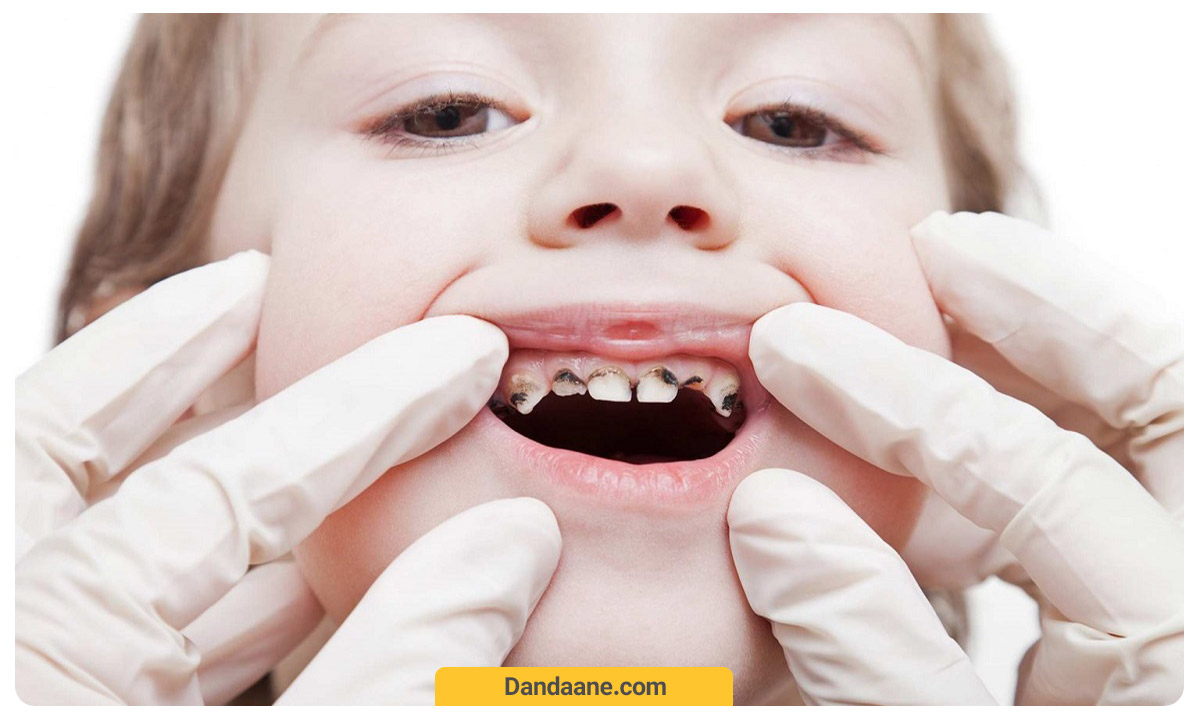بررسی پوسیدگی دندان کودک
