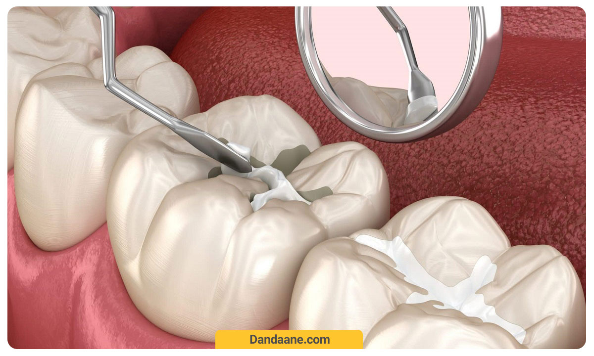 پرکردن حفره های دندان با سیلانت