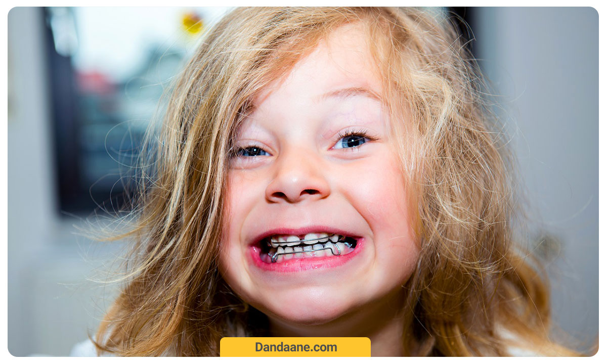 ارتودنسی متحرک روی دندان کودک