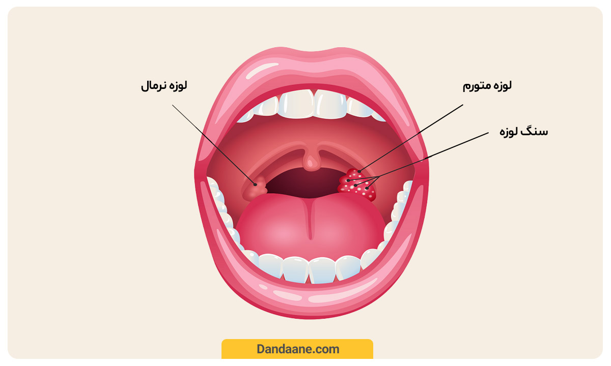 یک لوزه متورم و دارای سنگ