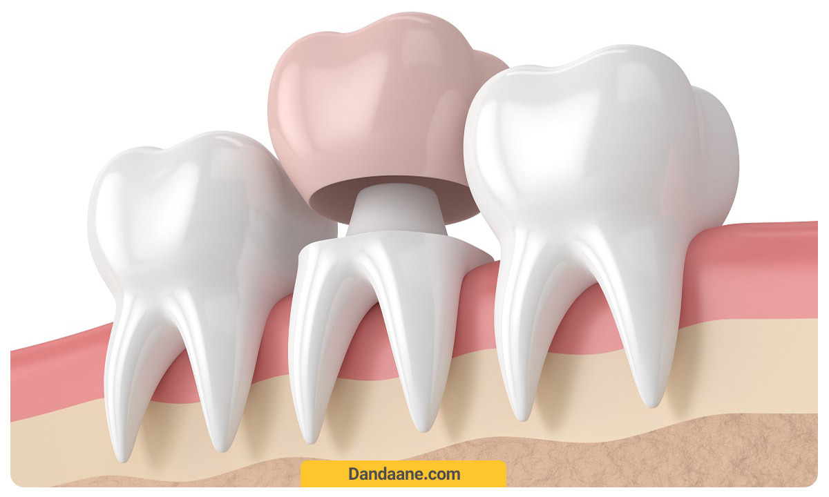 شمای کلی روکش دندان