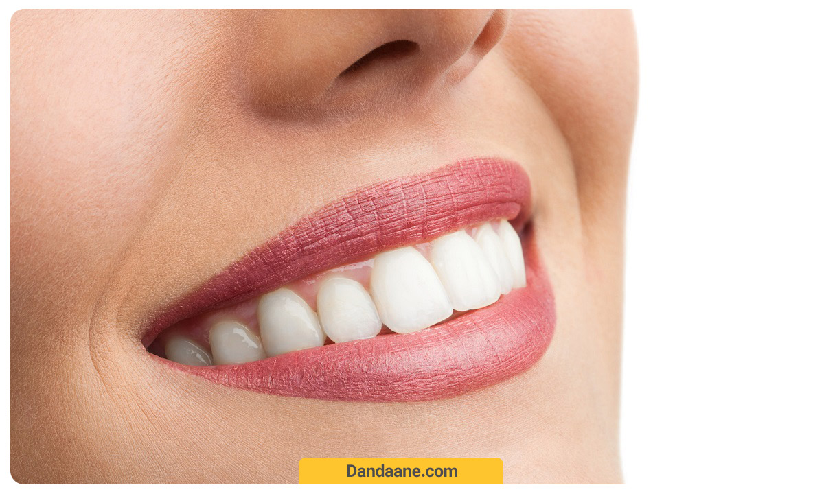 لبخندی کاملا طبیعی- دندانپزشکی زیبایی