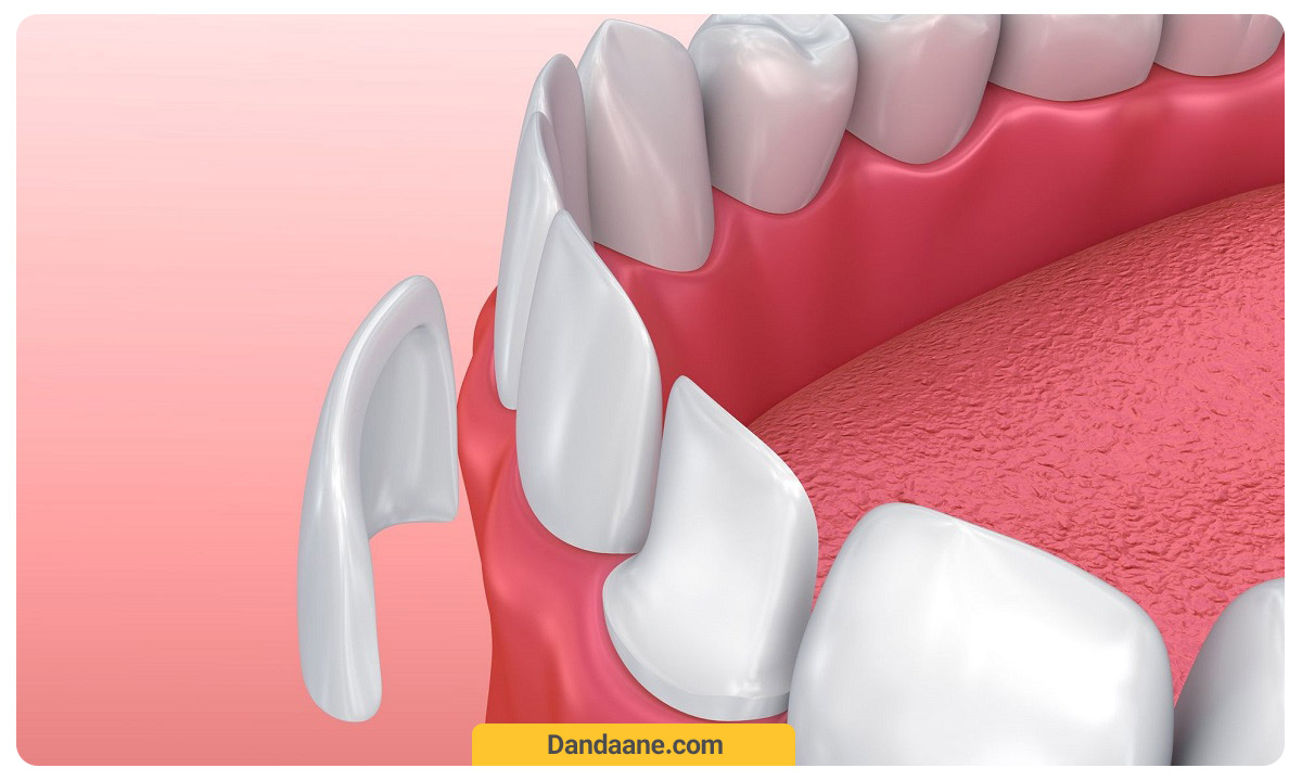 ونیر دندان-دندانپزشکی زیبایی