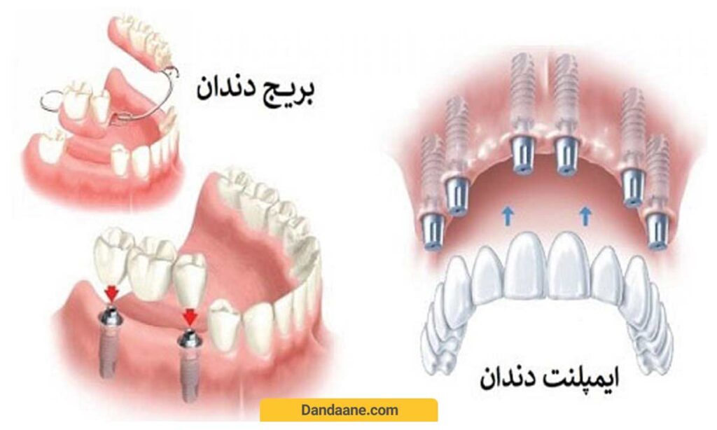 تفاوت بریج دندان و ایمپلنت دندان