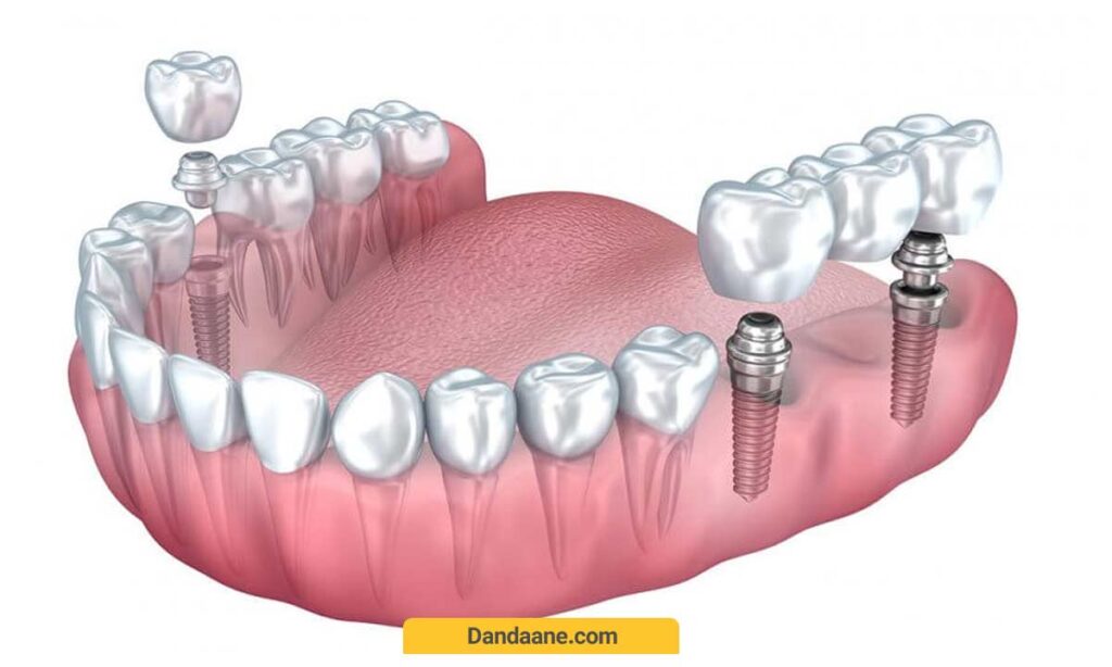 مزایا و معایب ایمپلنت دندان