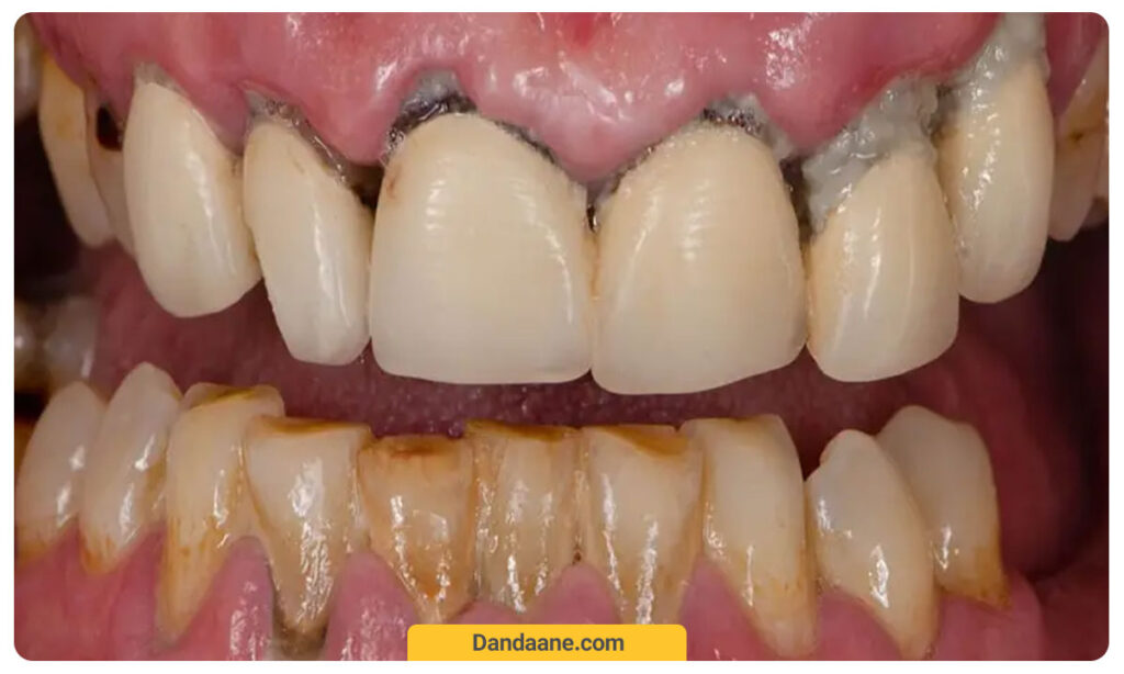 عکسی از بیماری لثه
