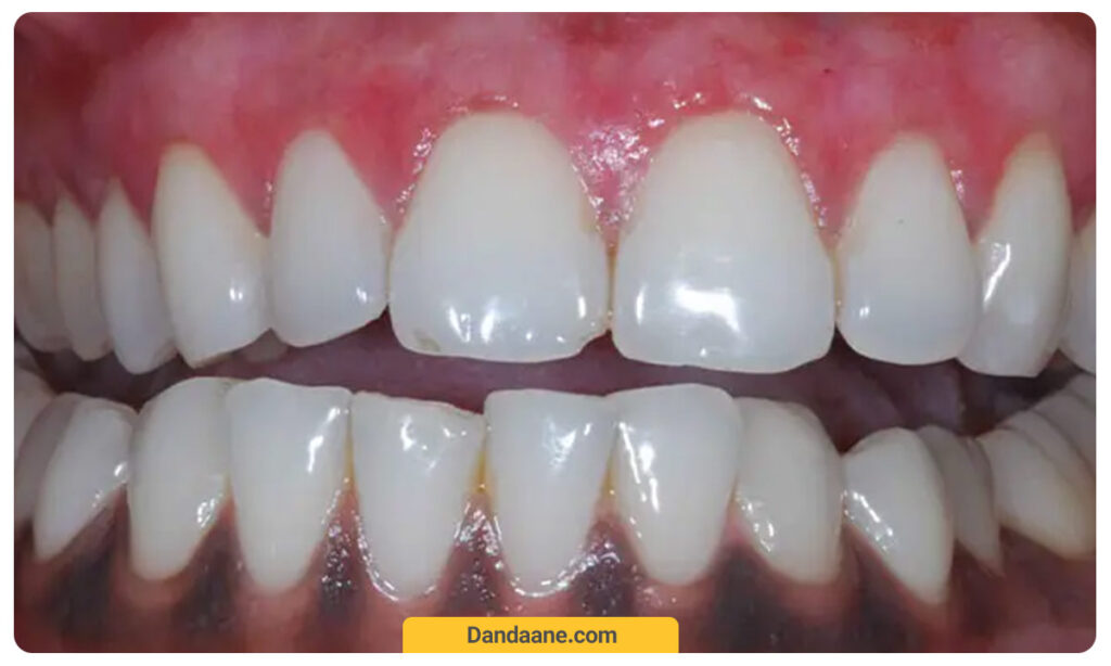 عکسی از تیرگی لثه ها