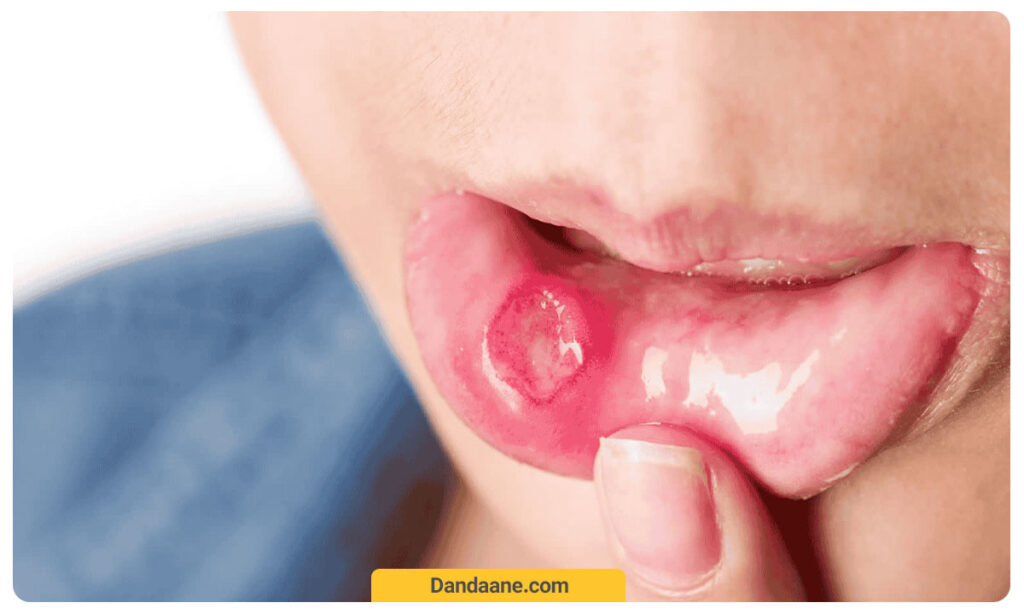 زخم دهان