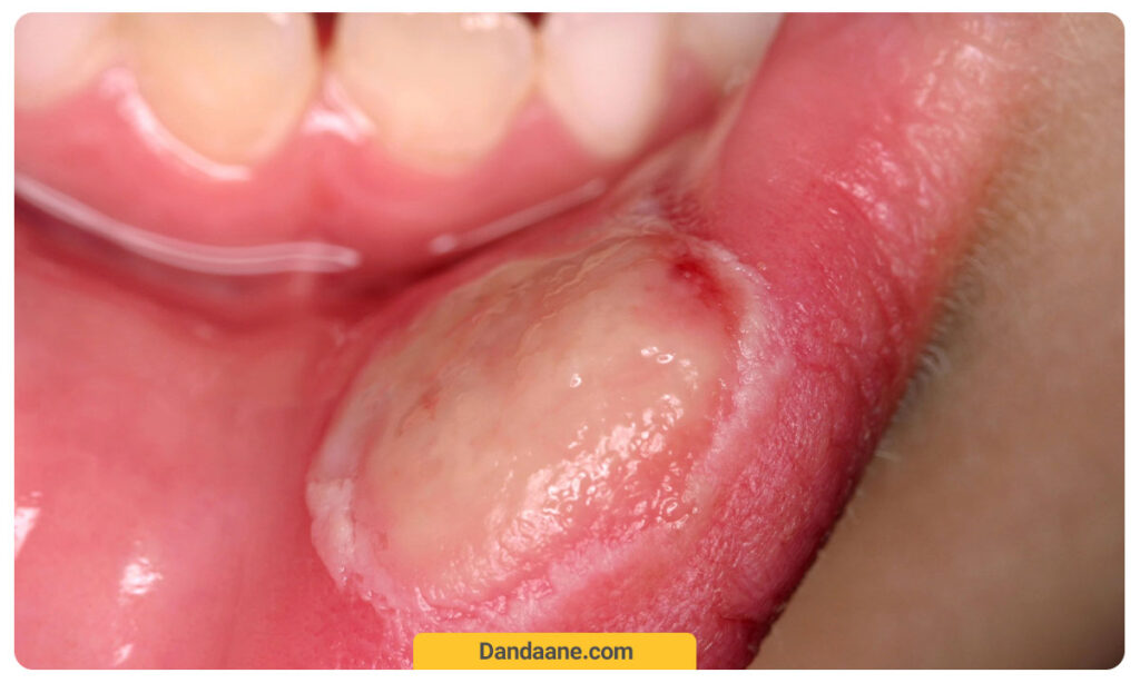 عکسی از زخم دهانی