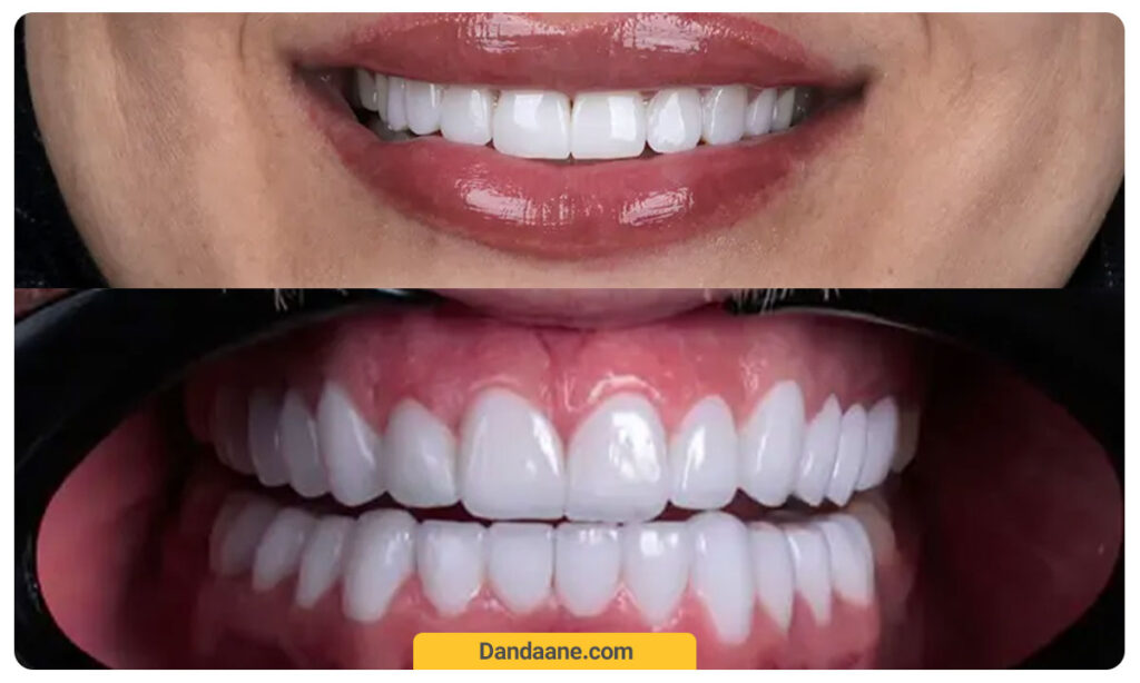 عکس فرق کامپوزیت و لمینت دندان از نظر شفافیت و زیبایی
