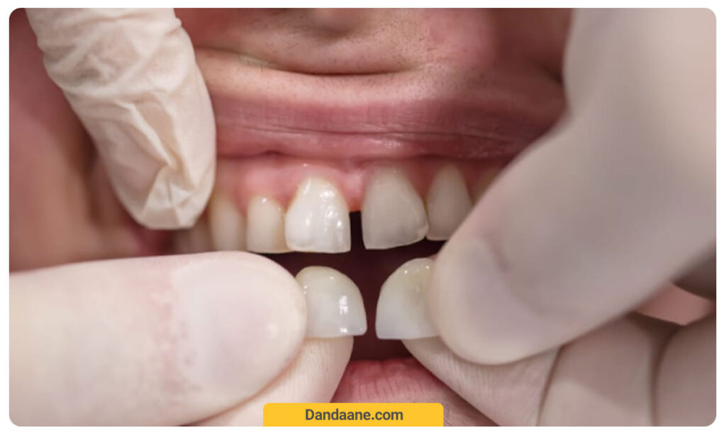 نصب ونیر کامپوزیتی دندان