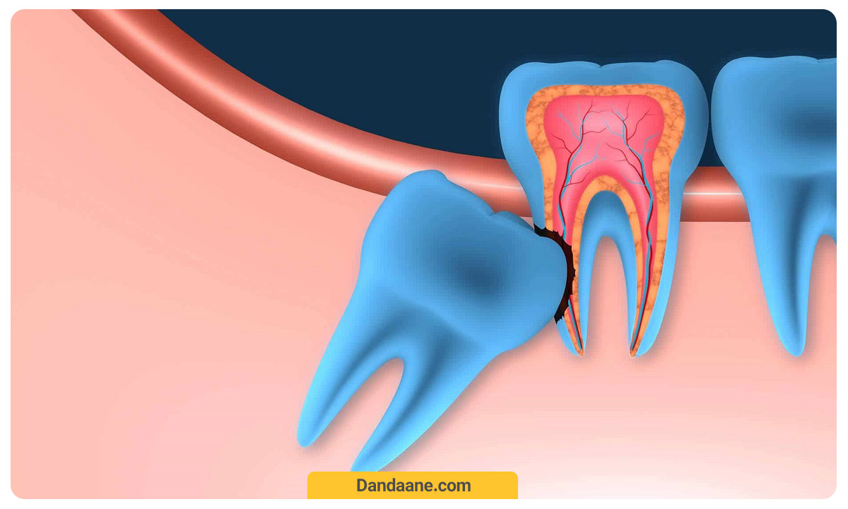 آُسیب دندان نهفته به اعصاب دندان مجاور