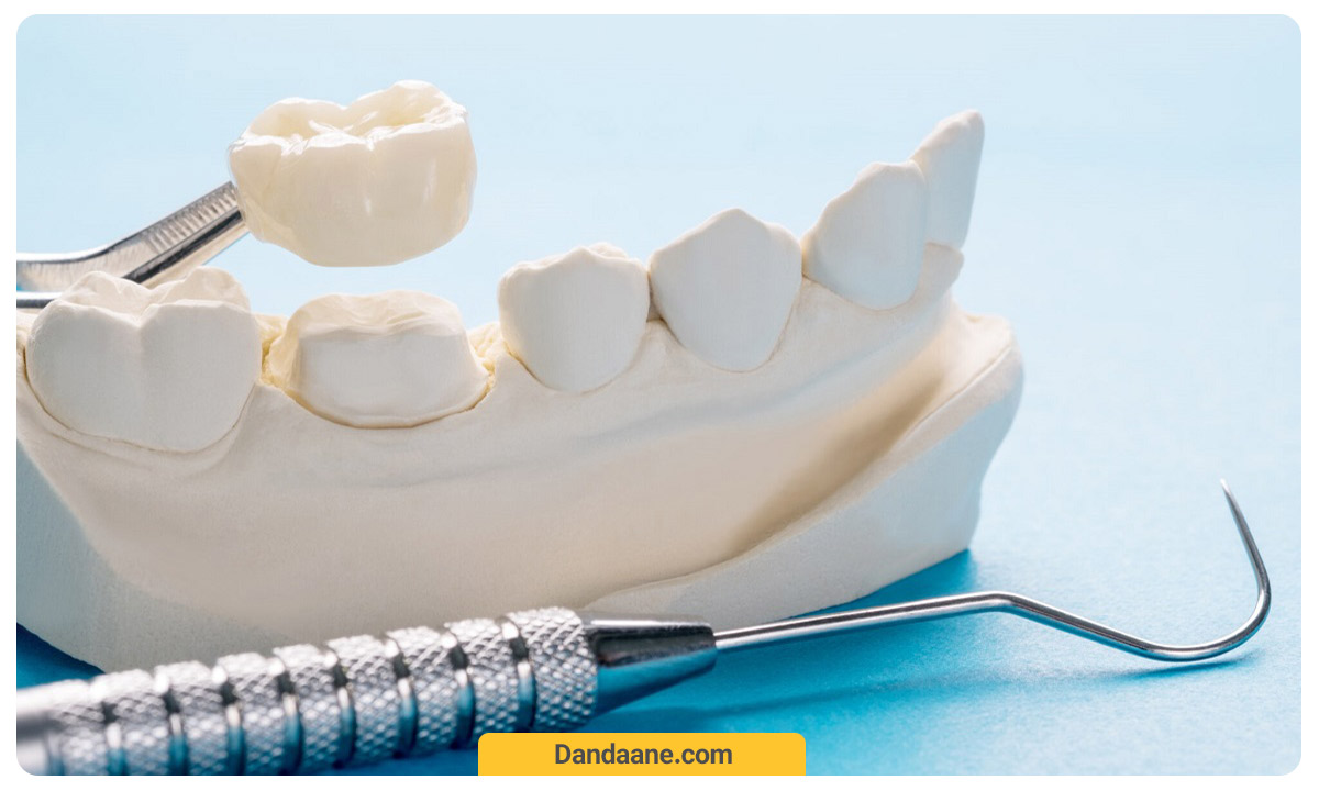 اتصال تاج به دندان