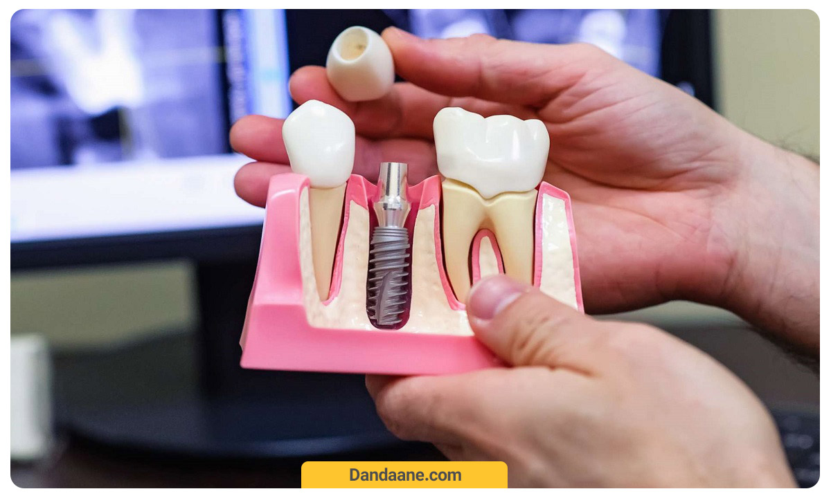 اجزای مختلف ایمپلنت دندان