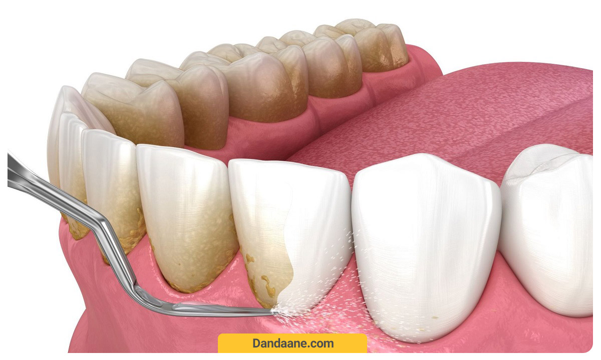 از بین بردن تارتارهای موجود بر روی دندان