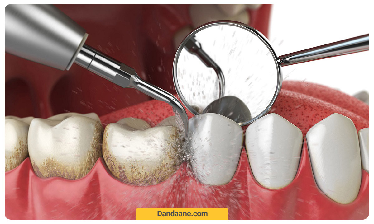 جرمگیری دندان با ابزارهای اولتراسونیک