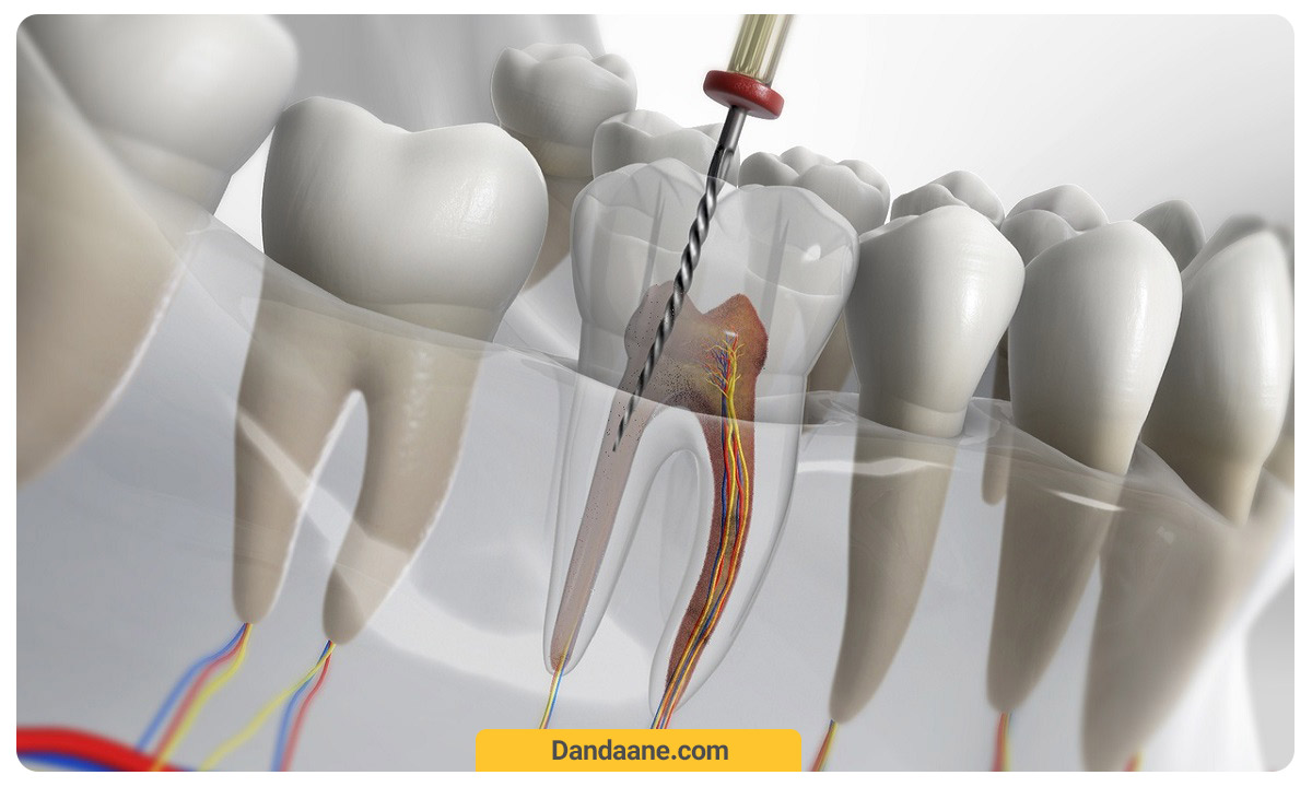 درمان کانال ریشه