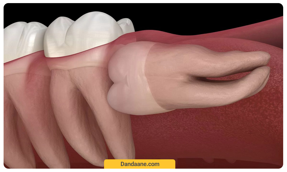 دندان عقل نهفته