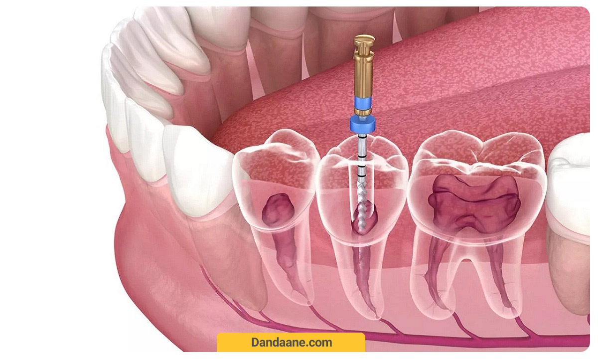سوراخ کردن دندان به جهت تخلیه پوسیدگی