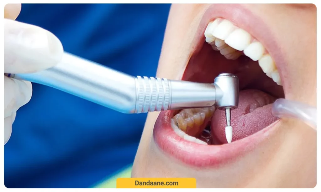 عکسی از عصب کشی دندان