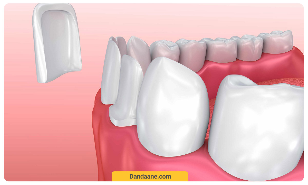 نحوه قرارگیری ونیر بر روی دندان